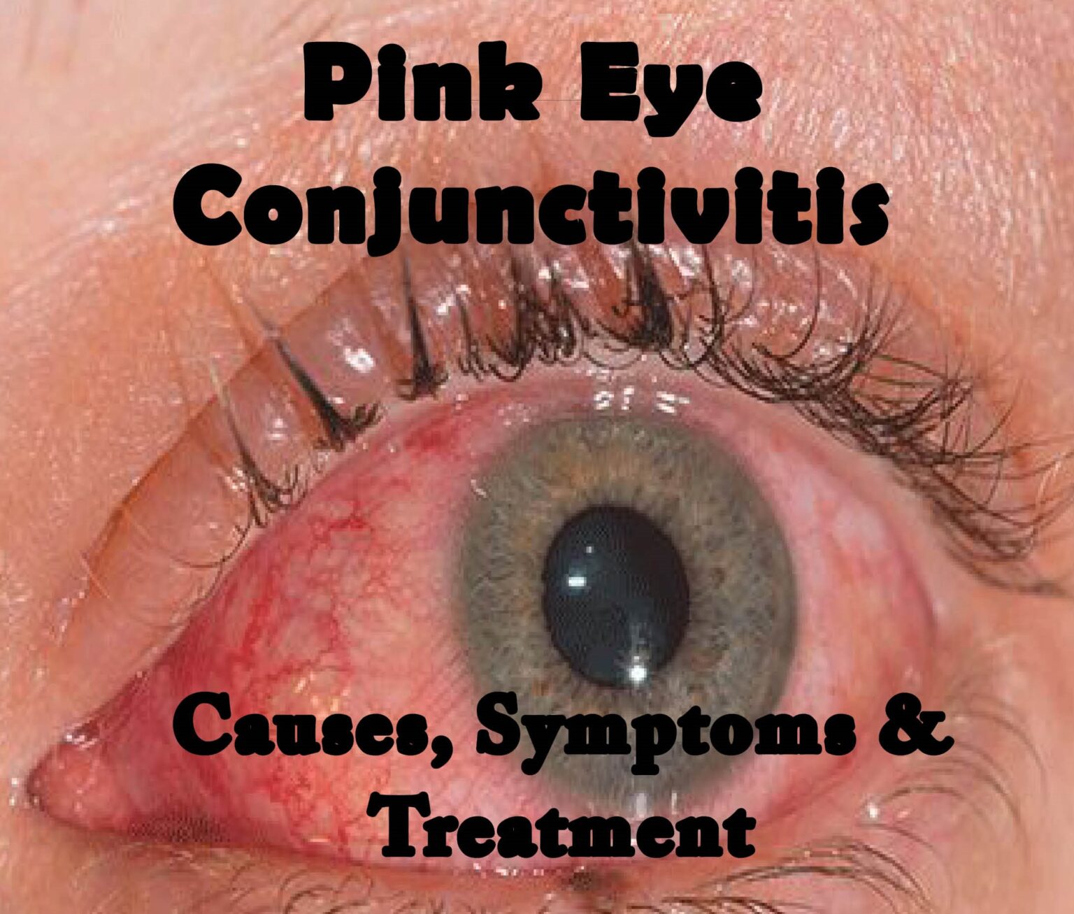 understanding-pink-eye-conjunctivitis-causes-and-treatment