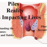 Unveiling the Reality: Piles Impacting Lives