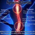 Spondylosis and its Impact on life