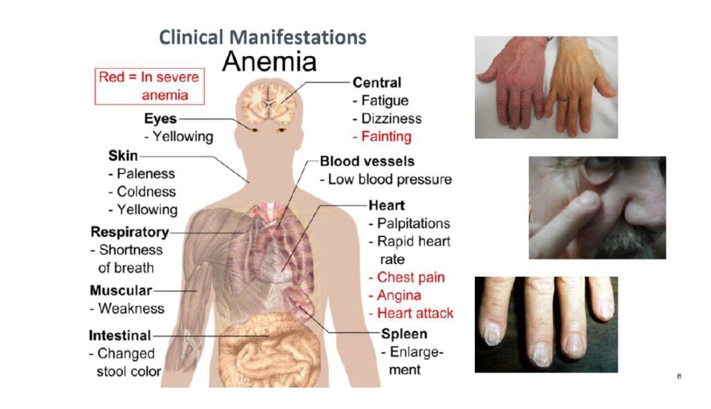 Iron injection for addressing Iron deficiency Anaemia.