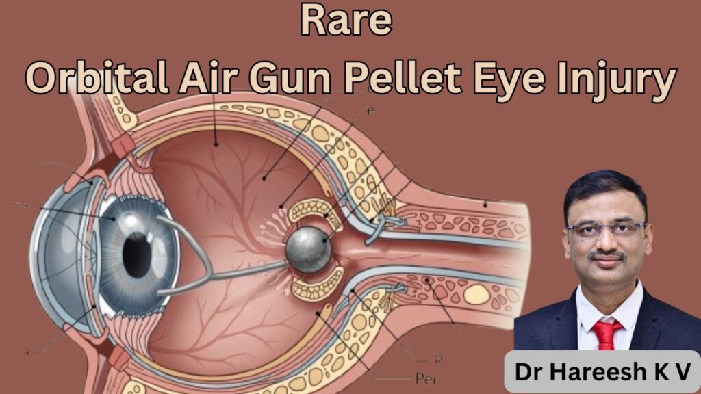 Rare Orbital Air Gun Pellet Eye Injury #abhisheknethradhama #drhareeshkv #eyehospital #yelahanka #vydyaloka #healthvision