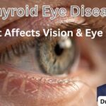 Thyroid Eye Disease - How It Affects Vision & Eye Health Thyroid Eye Disease #abhisheknethradhama #drhareeshkv #eyehospital #yelahanka #vydyaloka #healthvision #childeyecare #thyroideyedisease