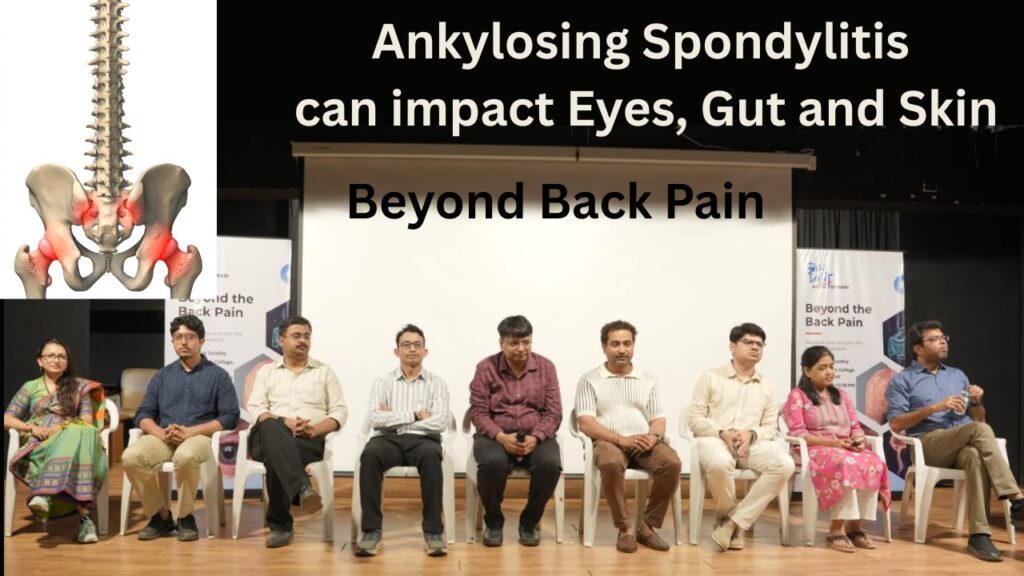 Ankylosing Spondylitis can impact Eyes, Gut and Skin #vydyaloka #healthvision