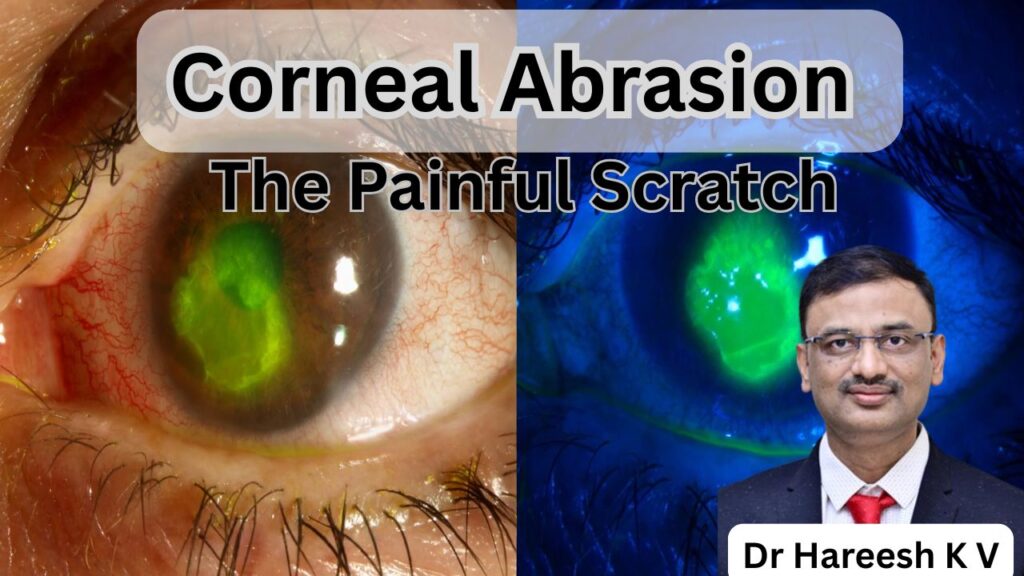 Corneal Abrasion #abhisheknethradhama #drhareeshkv #eyehospital #yelahanka #vydyaloka #healthvision