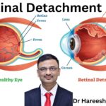 Retinal Detachment #abhisheknethradhama #drhareeshkv #eyehospital #yelahanka #vydyaloka #healthvision