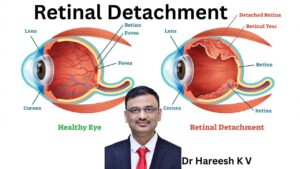Retinal Detachment #abhisheknethradhama #drhareeshkv #eyehospital #yelahanka #vydyaloka #healthvision